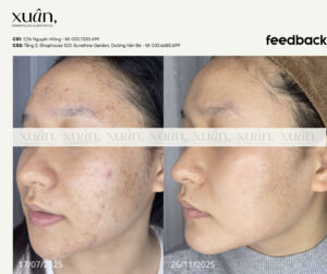 hiệu quả điều trị mụn