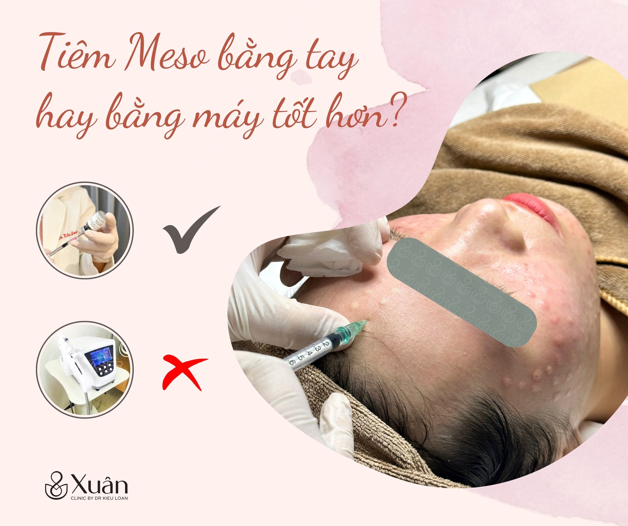 Tiêm meso