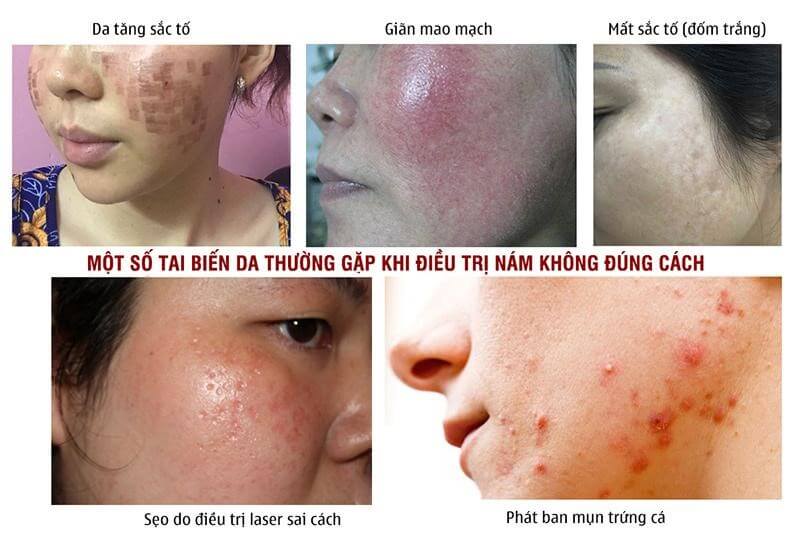 biến chứng điều trị nám sai 