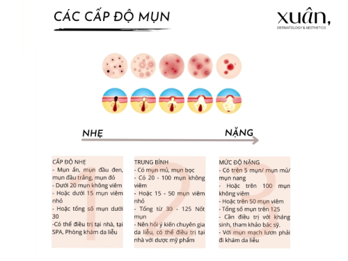 các cấp độ mụn