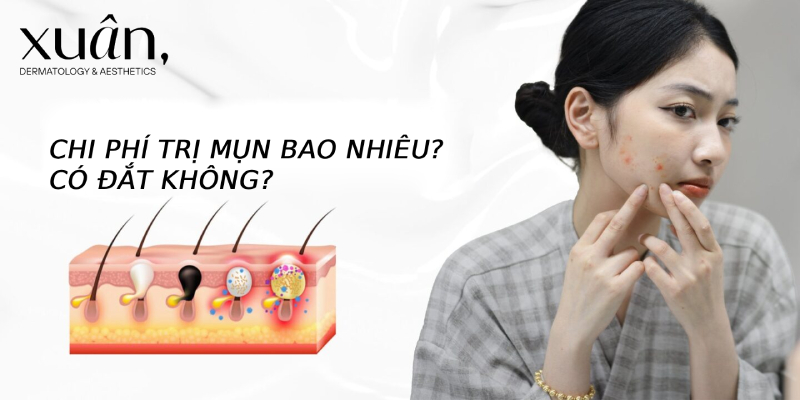 chi phí trị mụn