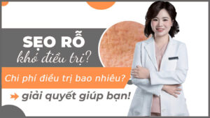 chi phí trị sẹo rỗ