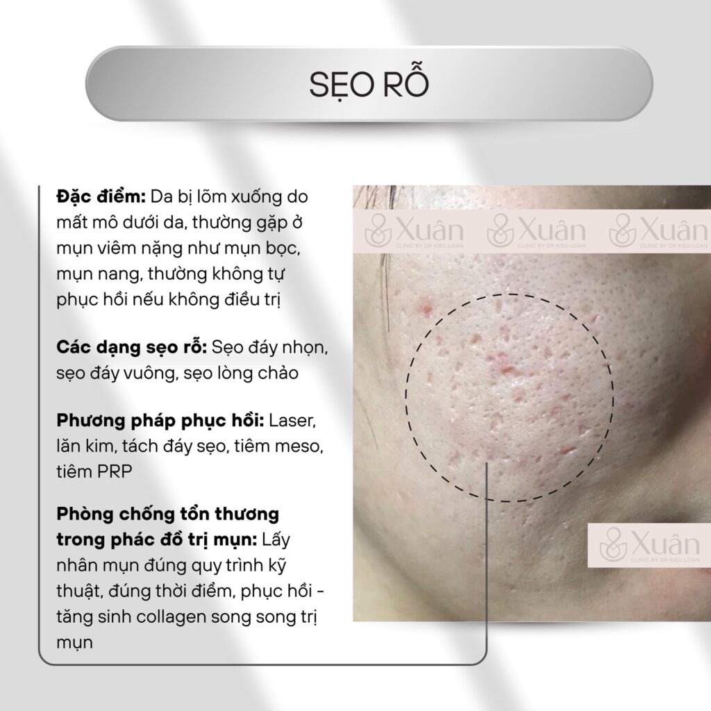 điều trị sẹo rỗ tại Xuân clinic