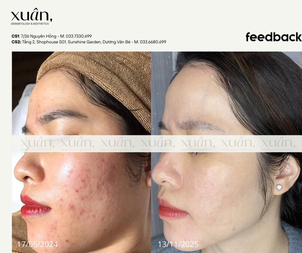 hiệu quả điều trị sẹo rỗ