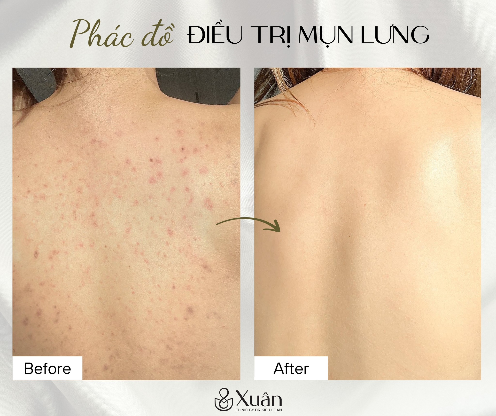 Trị Mụn Lưng Ở Đâu Hà Nội? Địa Chỉ Và Chi Phí Trị Mụn Lưng Hà Nội Mới Nhất