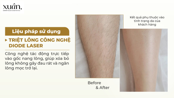 Chi Phí Triệt Lông Bao Nhiêu? Bảng Giá Triệt Lông Tại Hà Nội Hiện Nay