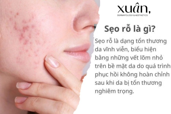 Sẹo rỗ là gì