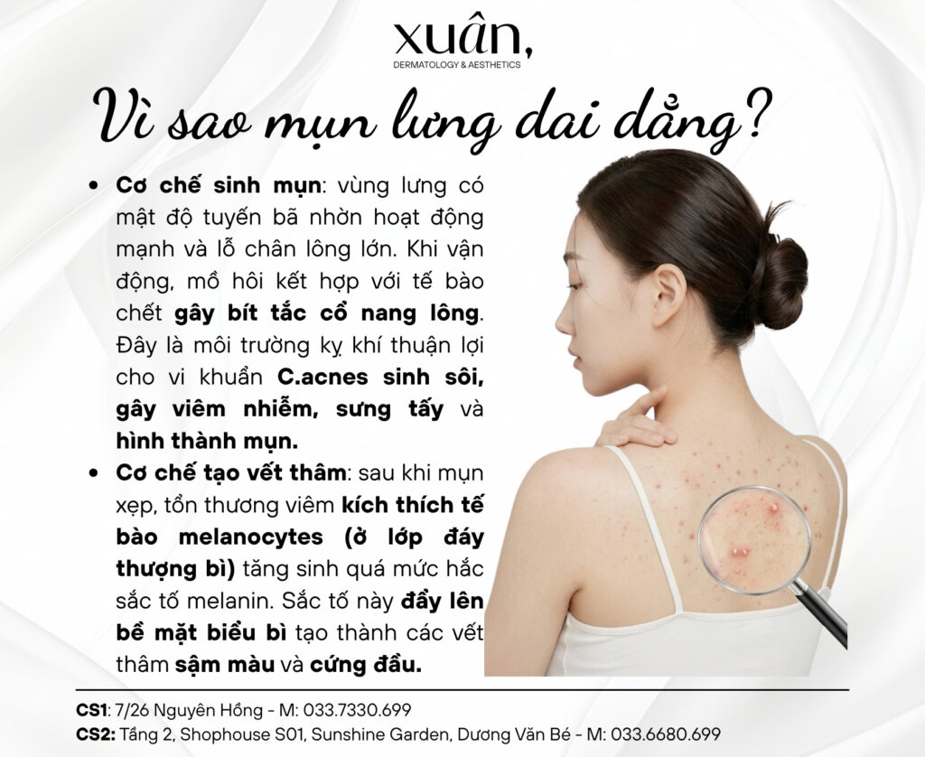 Nguyên nhân gây mụn lưng?