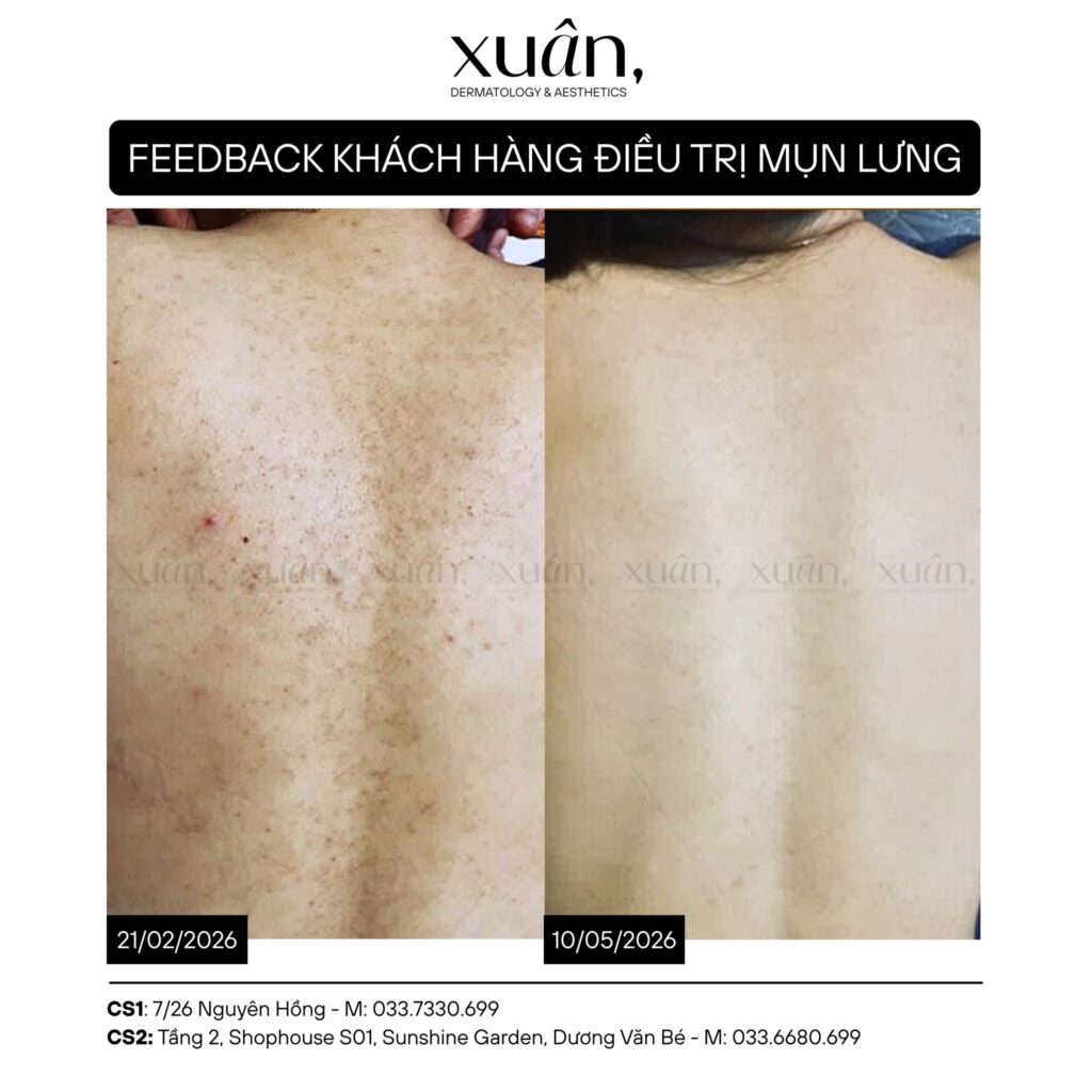 Feedback khách hàng điều trị mụn lưng