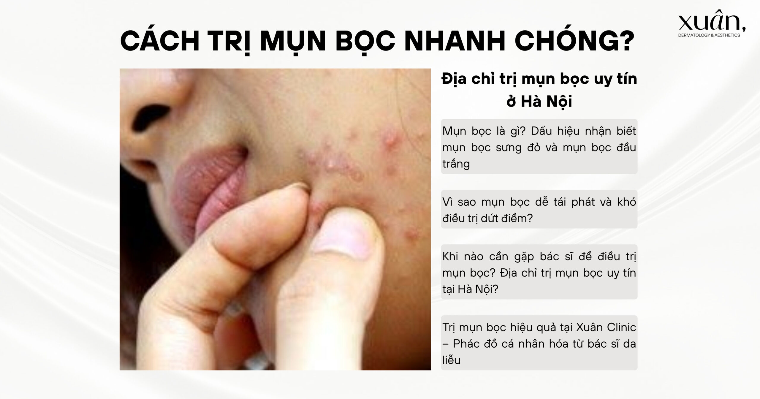 Cách Trị Mụn Bọc Nhanh Chóng? Địa Chỉ Trị Mụn Bọc Uy Tín Ở Hà Nội