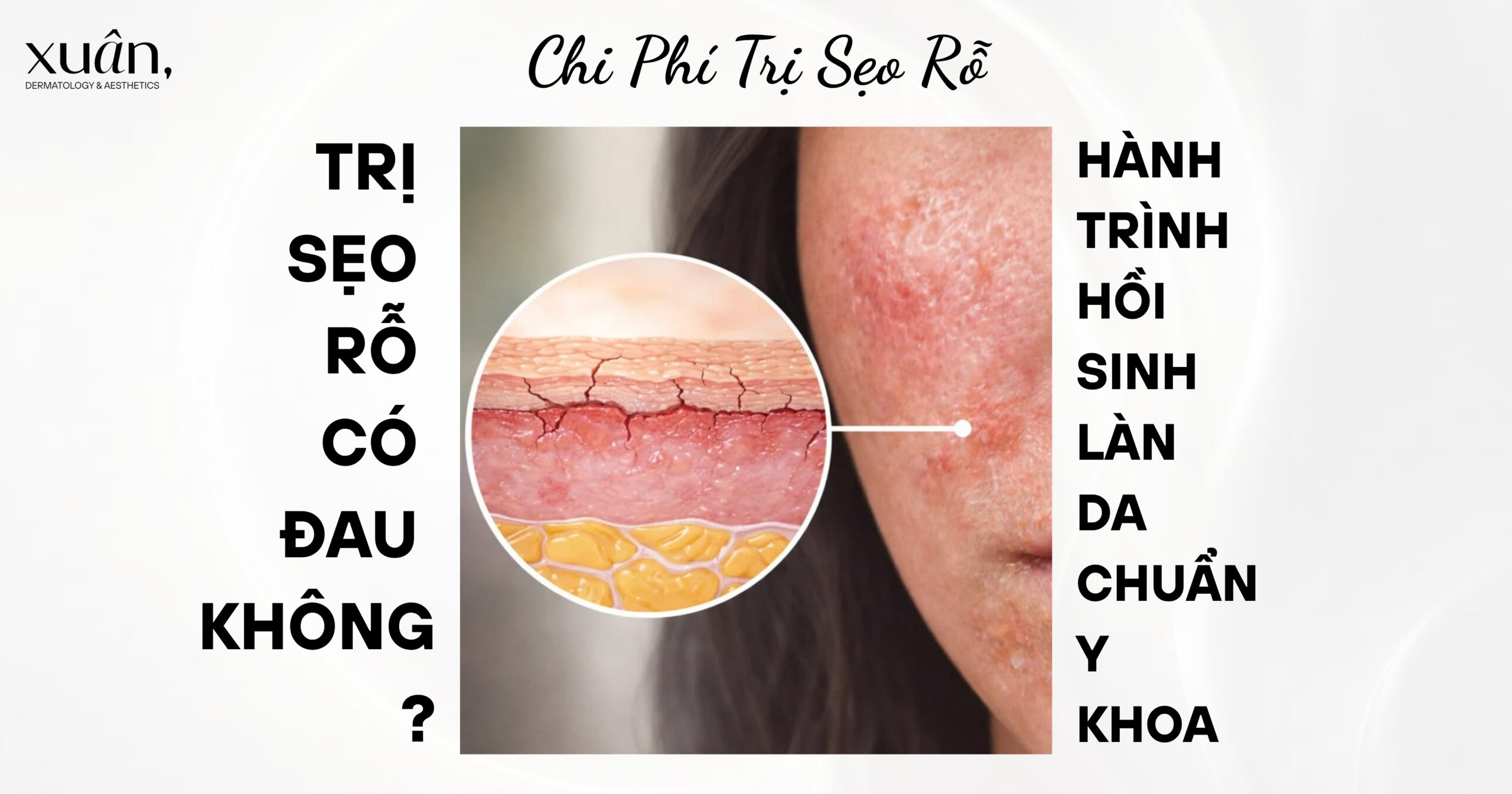 Trị Sẹo Rỗ Có Đau Không? Chi Phí Trị Sẹo Rỗ Và Phác Đồ Điều Trị Chuẩn Y Khoa
