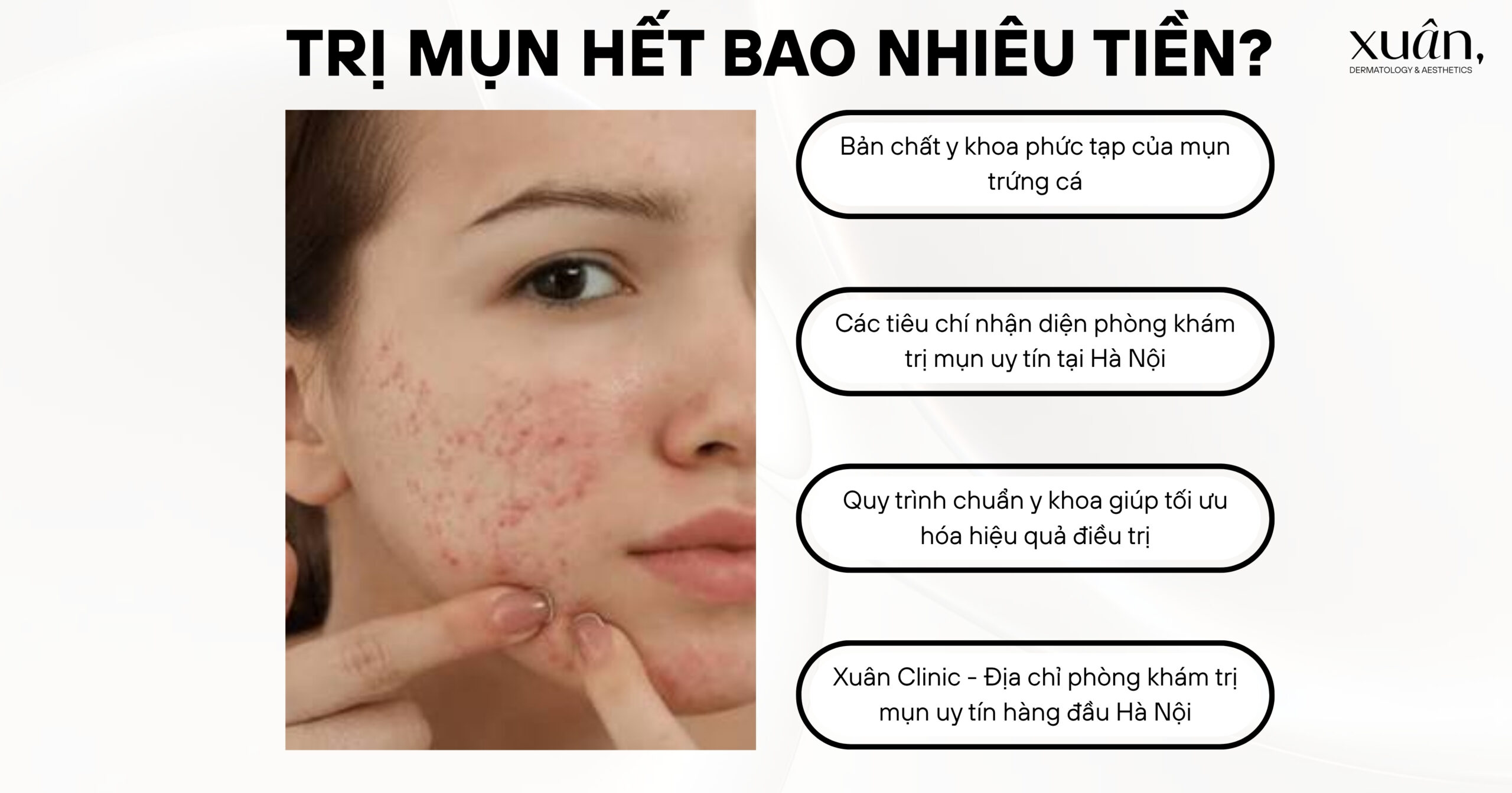 Trị Mụn Hết Bao Nhiêu Tiền? Địa Chỉ Trị Mụn Uy Tín Ở Hà Nội