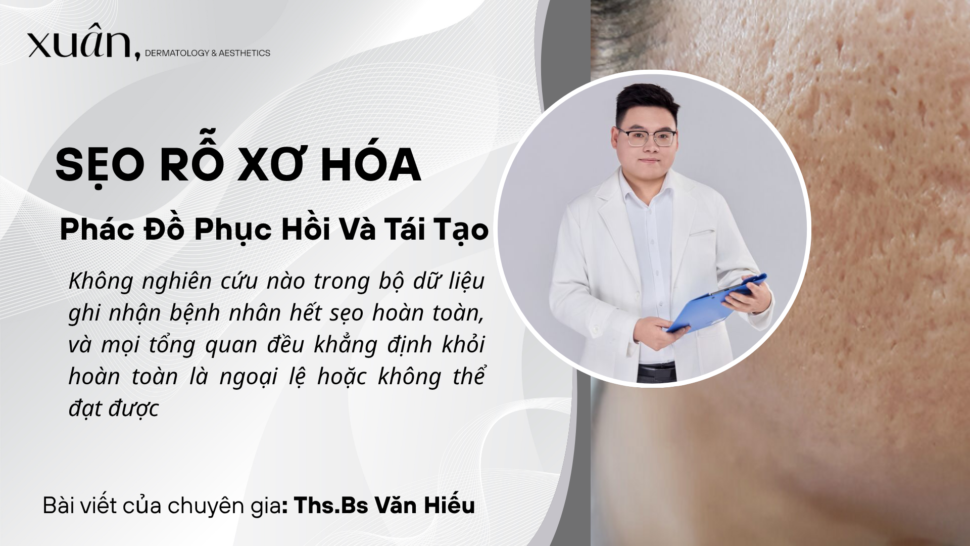 Sẹo Rỗ Bị Xơ Hóa Cứng Do Điều Trị Sai Cách: Phác Đồ Phục Hồi Và Tái Tạo Lại Cấu Trúc Da