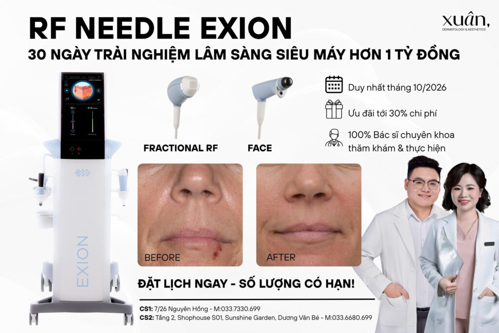 trải nghiệm dùng máy RF needling điều trị sẹo tại Xuân clinic